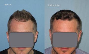Front view - Before and after