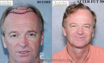 Hair restoration procedure before and after results