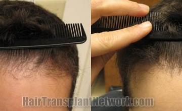 Before and after hair transplant procedure images