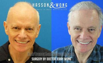 Before and after hair restoration procedure images