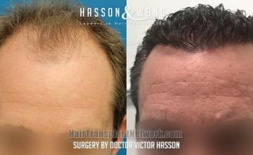 Front view - Before and after hair restoration procedure