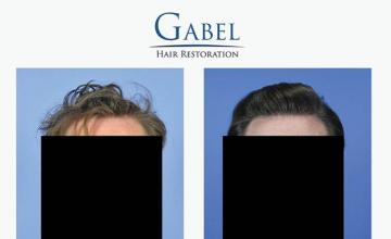 Front view - Before and after hair restoration procedure