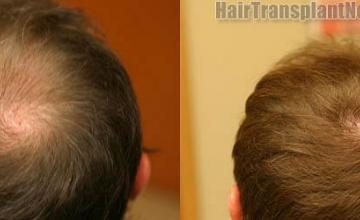 Hair transplantation surgery before and after photos