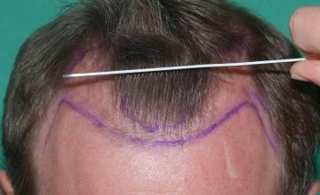 Hair transplantation surgery before and after pictures