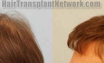 Hair transplantation surgery before and after photos