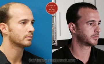 Hair transplantation surgery before and after images