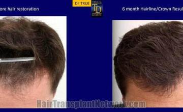 Surgical hair transplantation result photographs