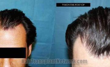 Top view before and after hair restoration results