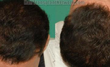 Hair transplantation surgery before and after photos