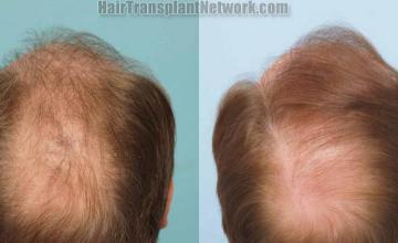 Hair transplantation surgery before and after pictures