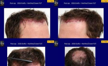 Surgical hair transplantationimmediate postoperative
