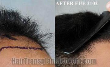 Hair transplantation surgery before and after photos