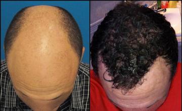 Before and after hair transplant procedure images