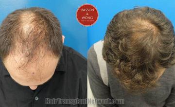 Hair transplantation surgery before and after pictures