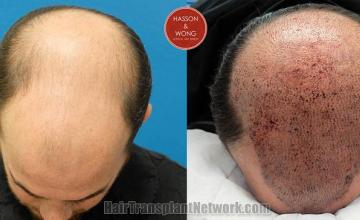 Hair restoration procedure before and after pictures