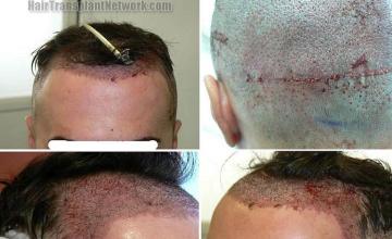 Hair restoration procedure before and after pictures