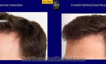 Hair transplantation surgery before and after photos