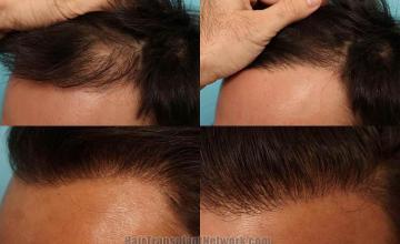 Hair transplantation surgery before and after pictures