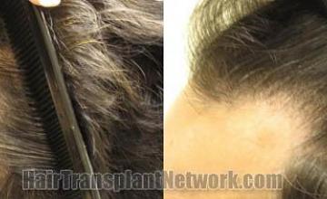Hair transplantation surgery before and after pictures