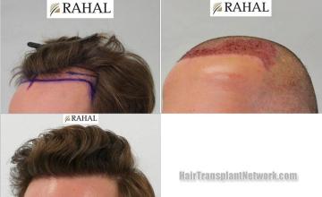 Hair transplantation surgery before and after photos