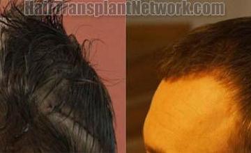 Hair transplantation surgery before and after images