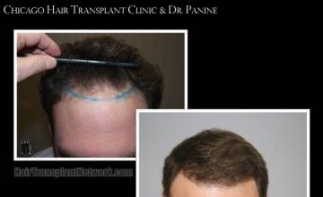 Hair transplantation surgery before and after images