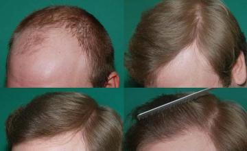 Before and after surgical hair restoration images