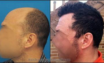 Hair restoration procedure before and after pictures