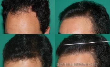 Hair transplantation surgery before and after images