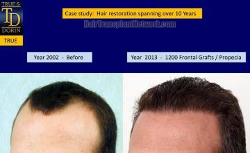 Hair transplantation surgery before and after images