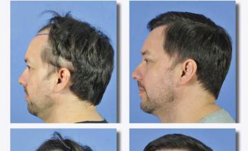 Hair restoration surgery before and after images