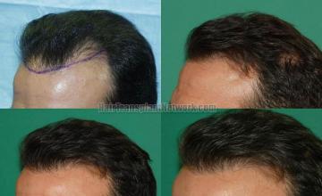 Hair transplantation surgery before and after pictures