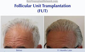 Hair transplantation surgery before and after pictures