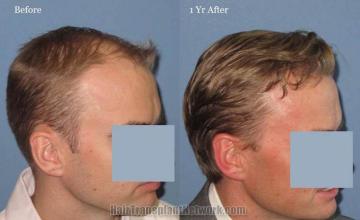 Hair restoration procedure before and after results