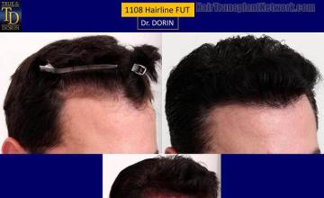 Hair transplantation surgery before and after images