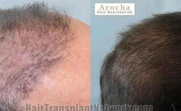 Hair transplantation surgery before and after photos