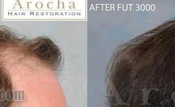 Hair transplantation surgery before and after images