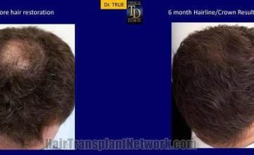 Before and after hair transplant procedure images