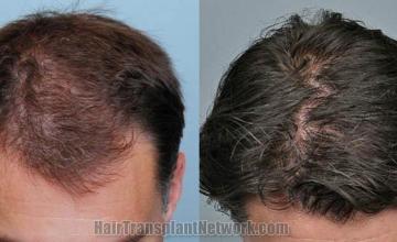 Hair transplantation surgery before and after photos