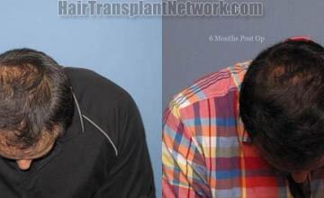 Hair transplant surgery before and after images