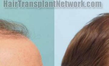 Hair transplantation surgery before and after photos