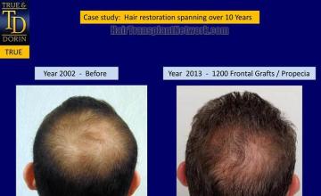 Hair transplantation surgery before and after pictures