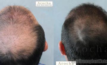 Hair transplantation surgery before and after images