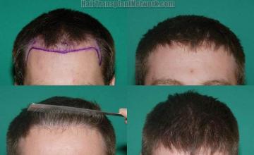 Before and after hair transplant procedure images