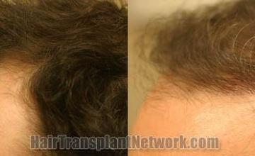 Hair transplantation surgery before and after pictures