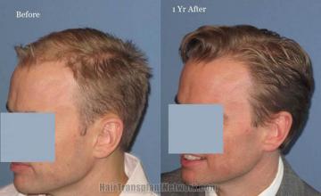 Hair transplantation surgery before and after photos