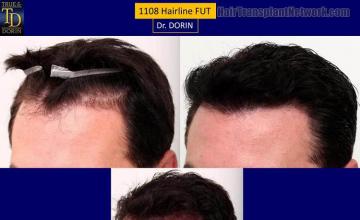 Hair transplantation surgery before and after pictures