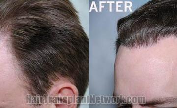 Hair transplantation surgery before and after images