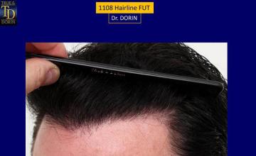 Hair restoration procedure before and after pictures