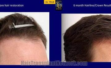 Hair restoration procedure before and after results